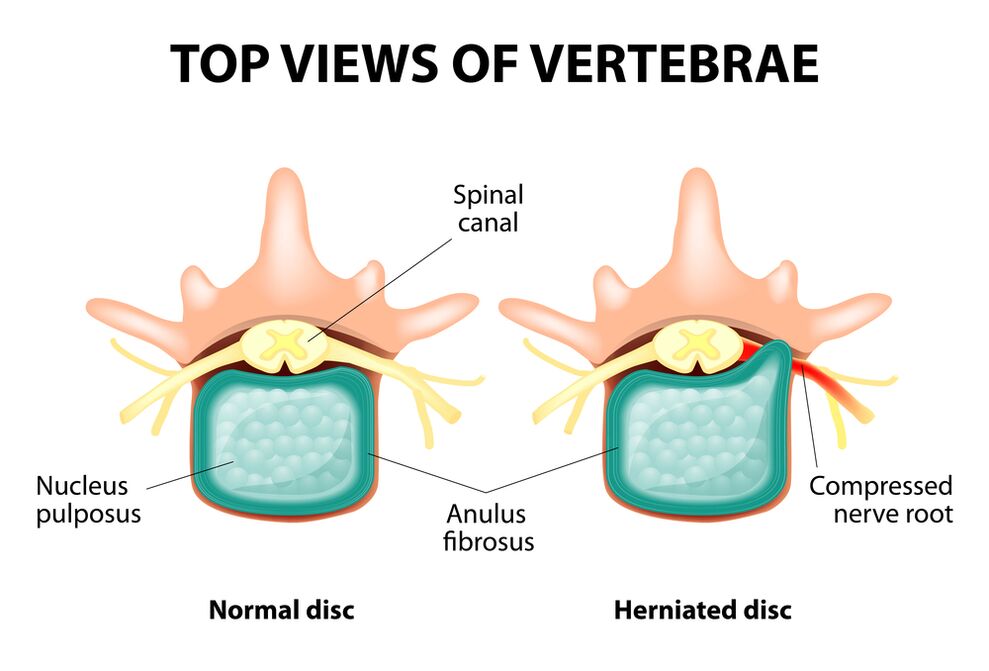 Disco intervertebral de Sano y Hernia