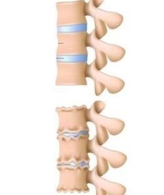 Las causas de la osteocondosis