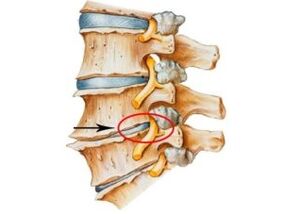 Signos y síntomas de osteocondosis