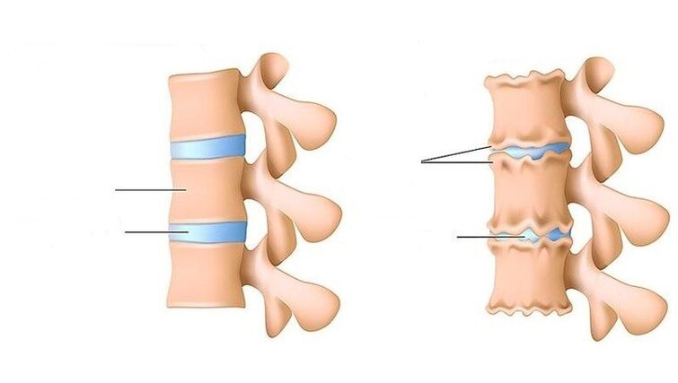 columna vertebral sana y columna afectada por osteocondrosis