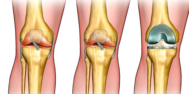 En la tercera etapa de la artrosis es necesaria la artroplastia de rodilla.