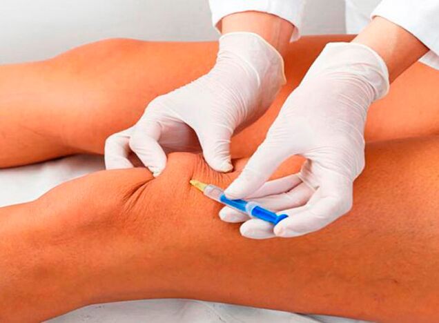 Inyecciones intraarticulares de medicamentos para la artrosis de la articulación de la rodilla.