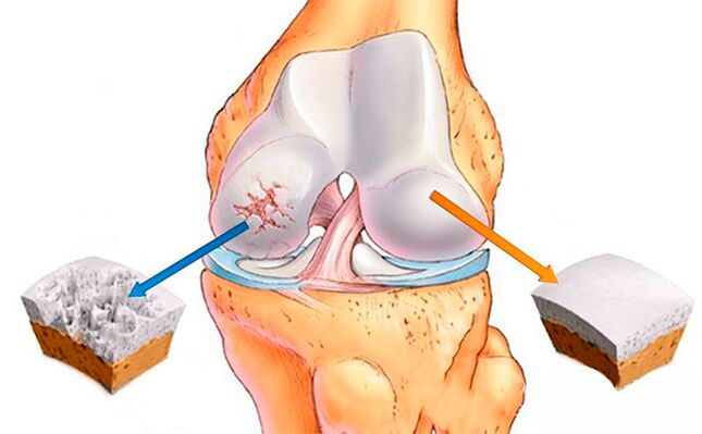 Una articulación de rodilla normal (derecha) y otra afectada por osteoartritis (izquierda)