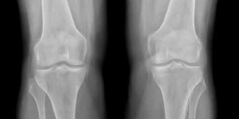 radiografía de la osteoartritis de la rodilla