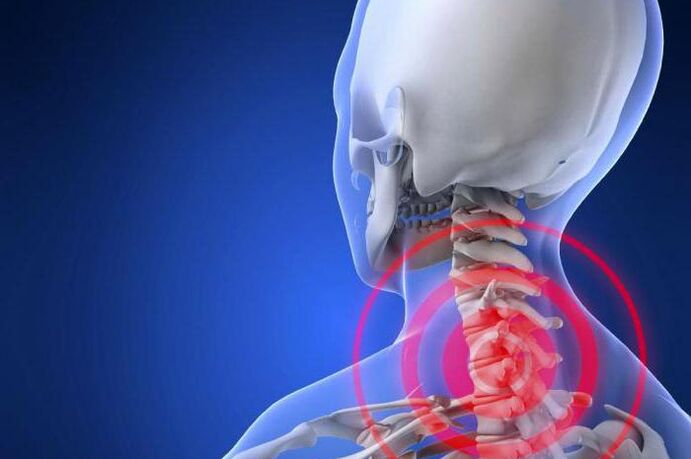 Dolor punzante en el cuello uno de los primeros síntomas de la osteocondrosis cervical