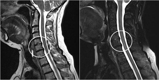 Resonancia magnética de la columna cervical con signos de osteocondrosis