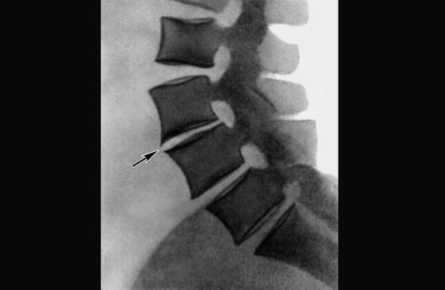 Manifestaciones de osteocondrosis de la columna torácica en la radiografía. 