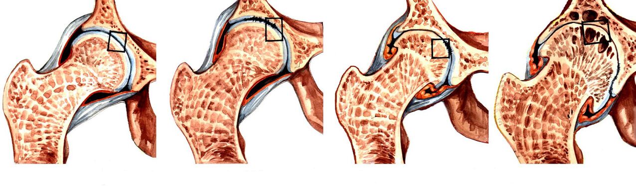 Grados de coxartrosis deformante